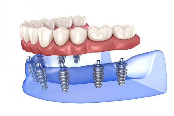 Dental Implant
